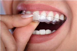 Invisalign Warminster PA