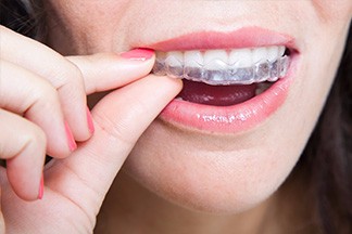 invisalign